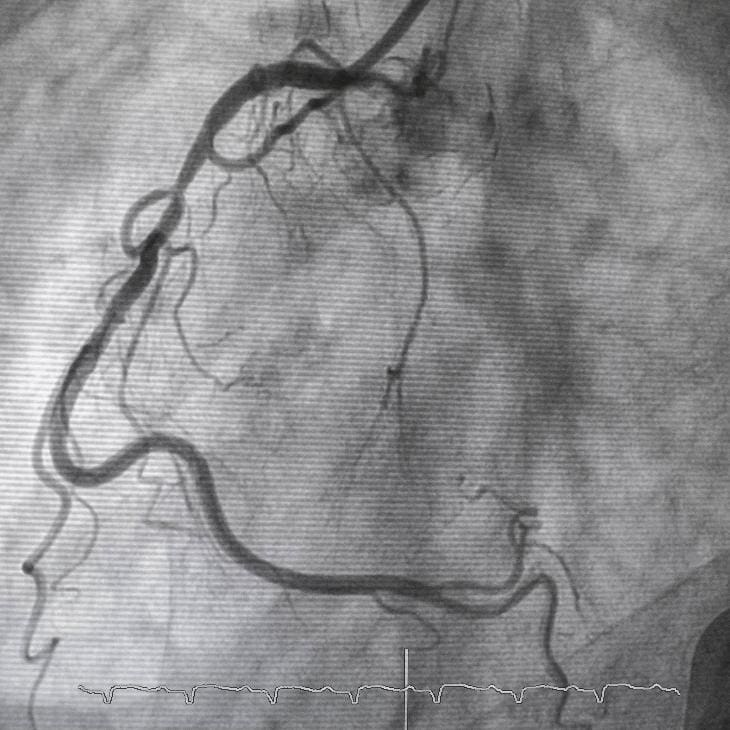cholesterol-dr-sayan-sen-2