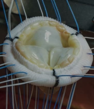 dr-sayan-sen-tavi-featured