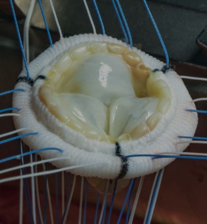 dr-sayan-sen-tavi-featured