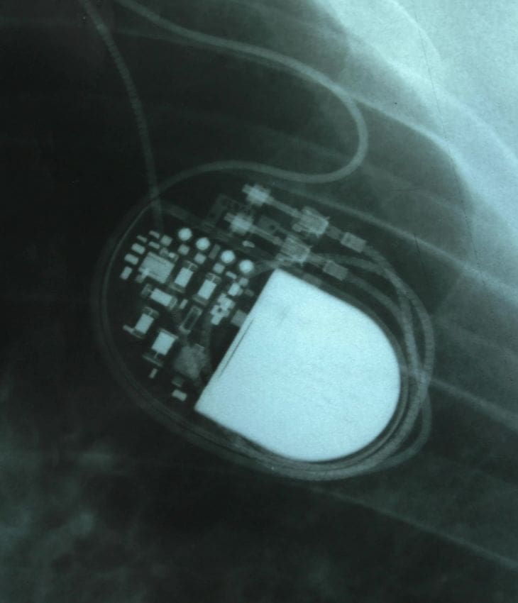 pacemaker-insertation-dr-sayan-sen-content-list